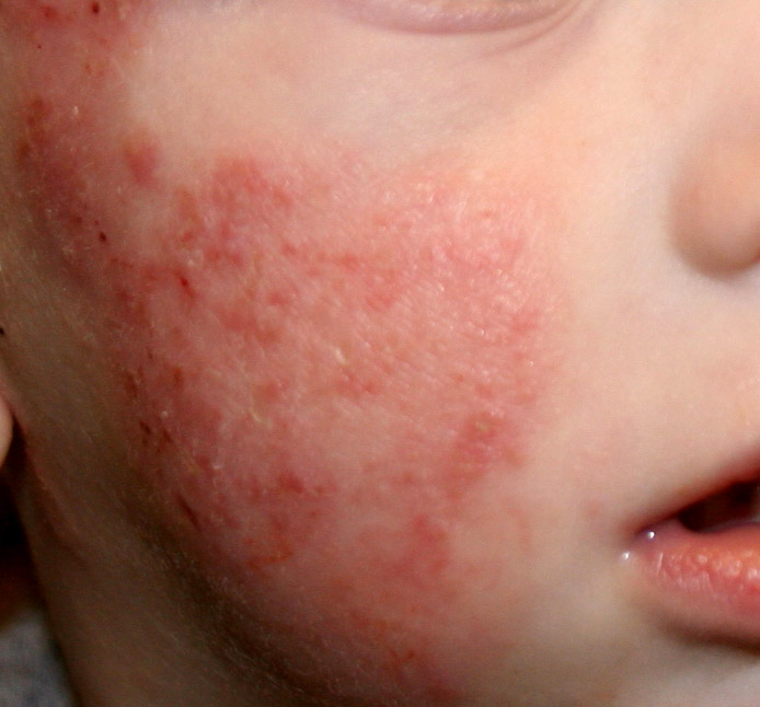 Dermatitis Atópica